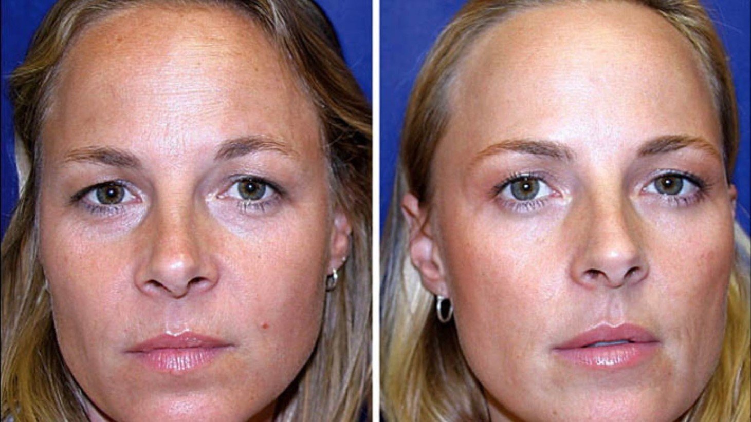 Side-by-side images of two identical female twins' faces against a blue background. The twin on the left shows visible signs of aging, such as fine lines around the eyes and mouth, while the twin on the right has a smoother complexion with fewer wrinkles, suggesting the effects of Botox treatments